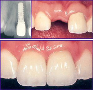 Dental-Implant-before-and-after