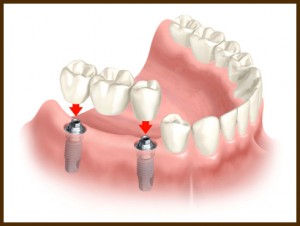 implant supported bridge