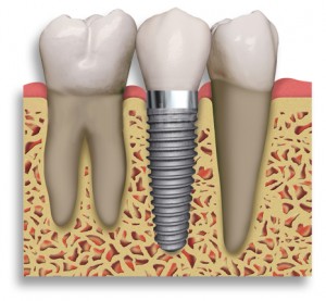 single tooth implant