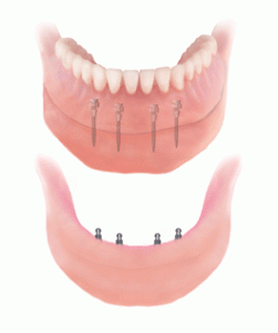 implant supportd denture